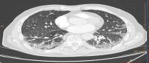 COVID-19 scans on Incisive CT scanner single technologist
