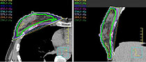 Radiation Oncology Education Pinnacle3 Webinar