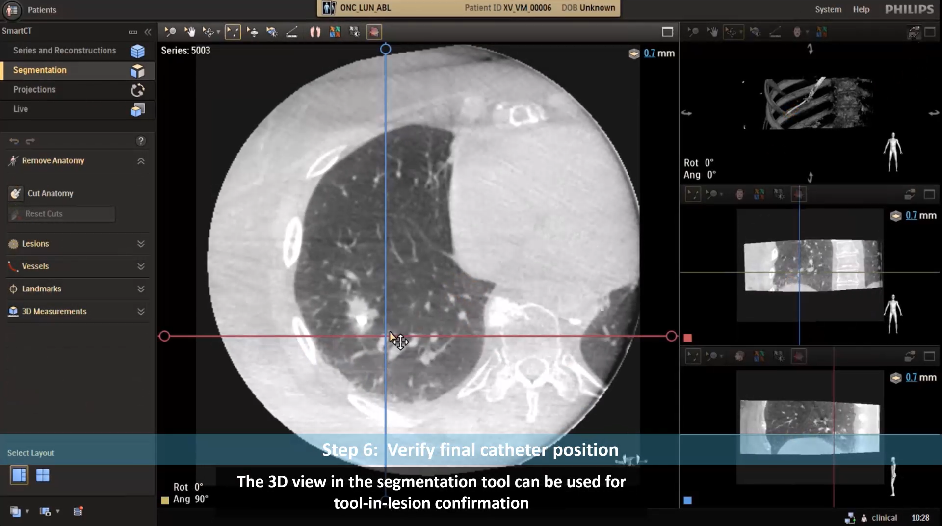 Lung Biopsy